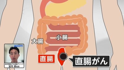 中村ゆりさんが患った直腸がんとは　若年患者は年間3000人超　「痔だと思っていたら…」血便・便秘など初期症状に注意