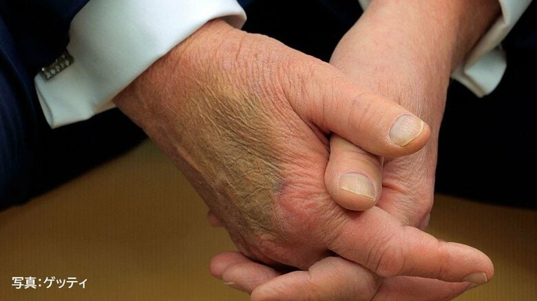 「化粧であざを隠しているように見える」ゲッティ社の写真（2月24日）