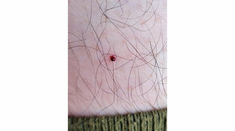 富良野でブヨに刺された直後（画像提供：足立さん）