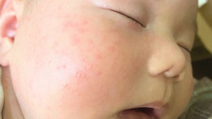 赤ちゃんのほっぺに赤いぷつぷつ…これも脂漏性皮膚炎