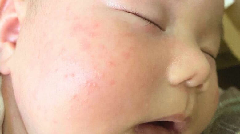 顔や頭皮がカサカサに…乳児や40代、50代に多い脂漏性皮膚炎　皮脂の分泌増える初夏は要注意｜FNNプライムオンライン
