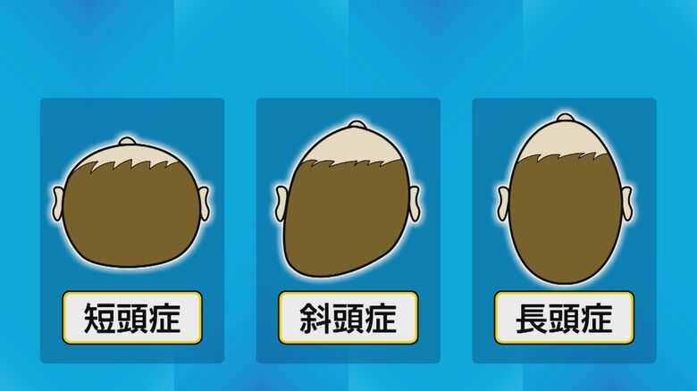 頭の変形のパターン