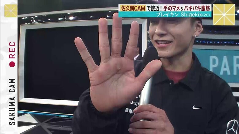 Shigekixの右手のマメ