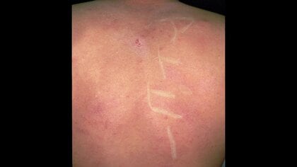 アトピー性皮膚炎は「完治も夢ではない」　3歳から症状がある皮膚科医が解説　新薬以外にサウナも効果的!?