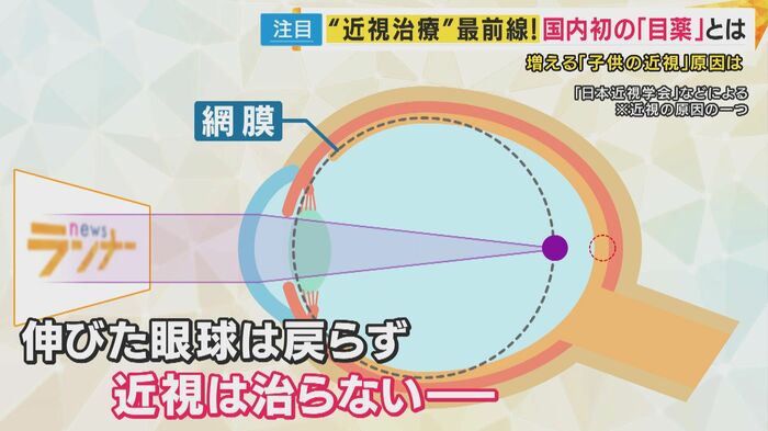 「近視」 起きる仕組みは