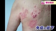 20代～40代で発症者が増加「帯状疱疹」　疲れやストレスで“免疫低下”しがちな年度末は特に注意【福井発】