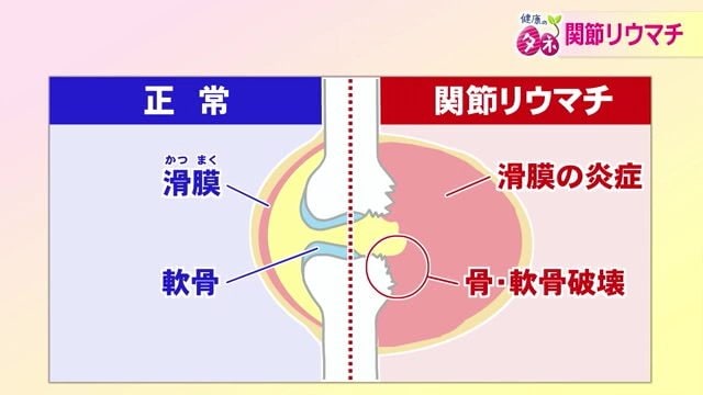 関節リウマチのメカニズム