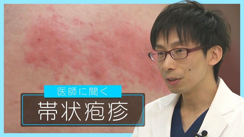 痛み伴う“帯状疱疹”なぜ発症？近年は若い世代でも増加傾向に…予防効果ある2種類の“ワクチン”メリット・デメリット踏まえ判断を｜FNNプライムオンライン