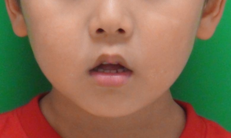 「お口ぽかん」の子ども 提供:齊藤一誠教授