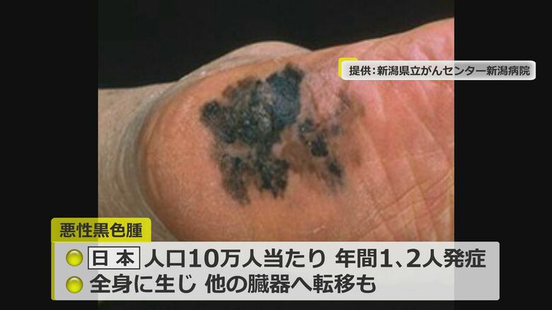 メラノーマは10万人に1人～2人が発症
