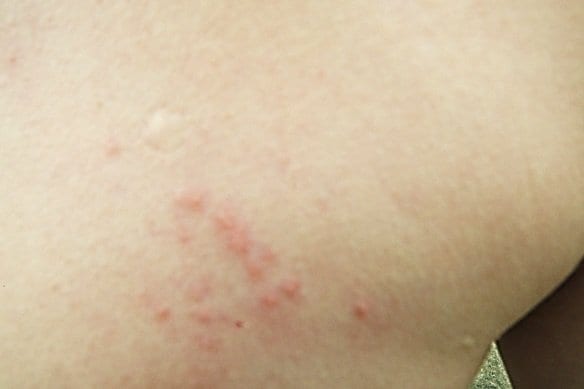 発疹が出た、初期段階の患部（写真提供：足立氏）