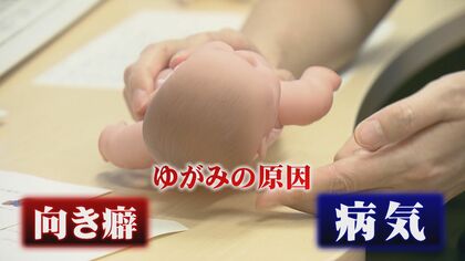 お子さんの頭の形気になりますか？「向き癖」かそれとも「病気」か…早期発見と治療が大切　専門外来が助言【島根発】