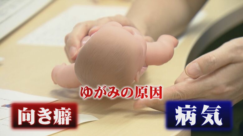 お子さんの頭の形気になりますか？「向き癖」かそれとも「病気」か…早期発見と治療が大切　専門外来が助言【島根発】｜FNNプライムオンライン