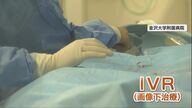 「死亡率90％」の大動脈瘤破裂やがん　体の負担を軽減する最新“ピンポイント治療法”【石川発】