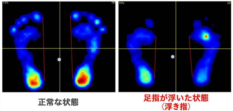 正常な足(左)と「浮き指」の比較(提供:橋間診療所)