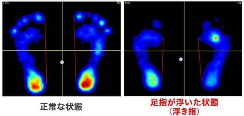 正常な足(左)と「浮き指」の比較（提供：橋間診療所）