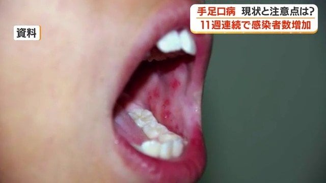 手足口病の症状