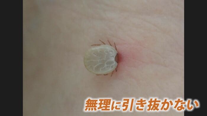 刺されたら無理に引き抜かない