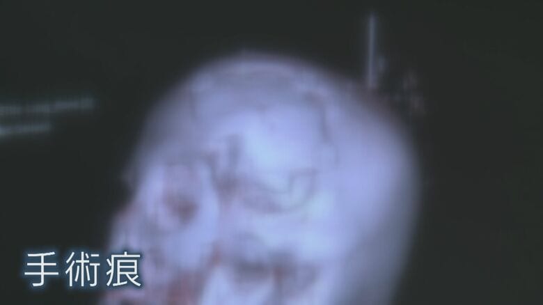 CT画像から手術痕を確認