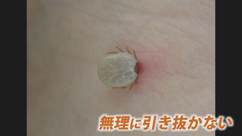 刺されたら無理に引き抜かない