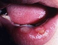 キス１回で感染も...“偽装の達人”「梅毒」　仙台市で過去最多に「なぜ」？〈宮城〉