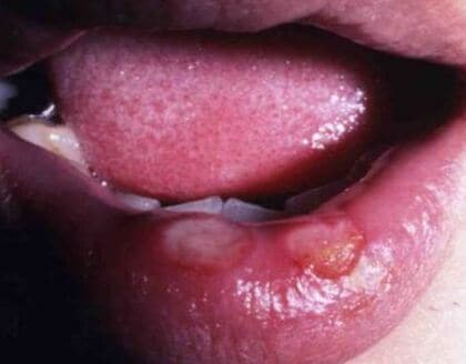 キス１回で感染も...“偽装の達人”「梅毒」　仙台市で過去最多に「なぜ」？〈宮城〉