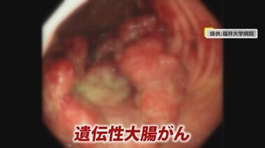 年間5万人が死亡　大腸がんの35％が遺伝性…若年で発症も　親族が発症したら気を付けるべ…