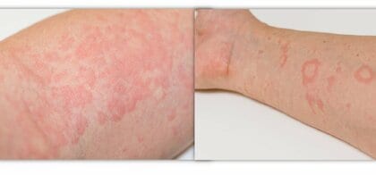 【マスクは効果なし】海外旅行“解禁”で感染者が！　“妊婦”と“30～50代”要注意の「はしか」　1人から18人に感染拡大