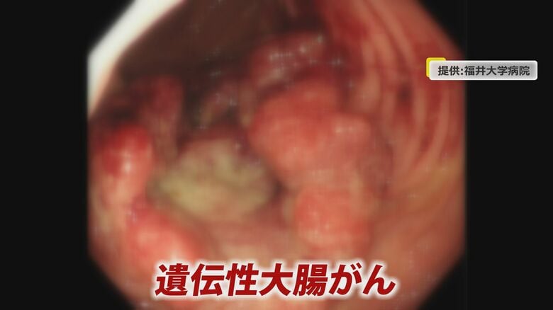 年間5万人が死亡　大腸がんの35％が遺伝性…若年で発症も　親族が発症したら気を付けるべき4つのサイン｜FNNプライムオンライン