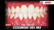歯茎からの出血が「歯周病」の引き金に　免疫力が下がっている時は要注意　糖尿病、心疾患、認知症のリスクも増大