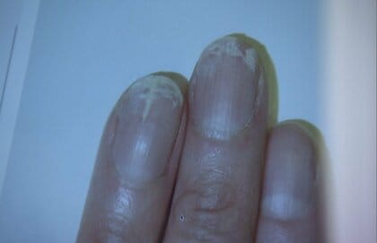 冬の乾燥は“爪”にも注意！割れたり剥がれたりする「二枚爪」や「ぜい弱爪」が増加中…乾燥による爪トラブルを悪化させない2つの予防法