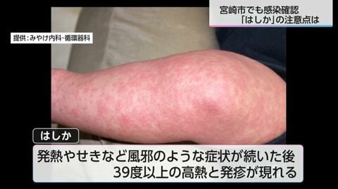 感染力はインフルエンザの約10倍!?　宮崎市で7年ぶりの｢はしか｣感染を確認　驚異の感染力から身を守るために今できること