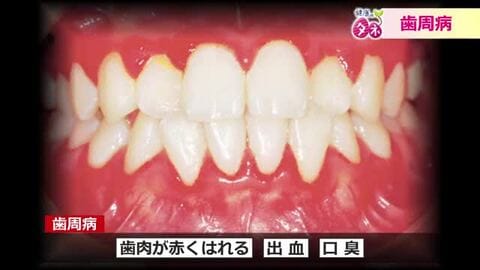 歯茎からの出血が「歯周病」の引き金に　免疫力が下がっている時は要注意　糖尿病、心疾患、認知症のリスクも増大