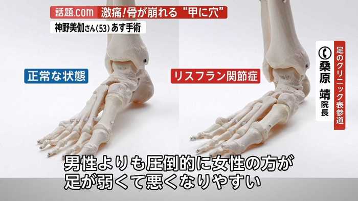 神野美伽(53)手術へ 足の骨に穴が開き激痛が走る「リスフラン関節症」とは？