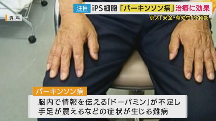 「パーキンソン病」手足が震えるなどの症状が生じる難病