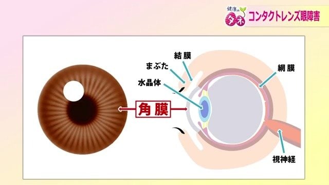 最も注意すべき角膜の感染症