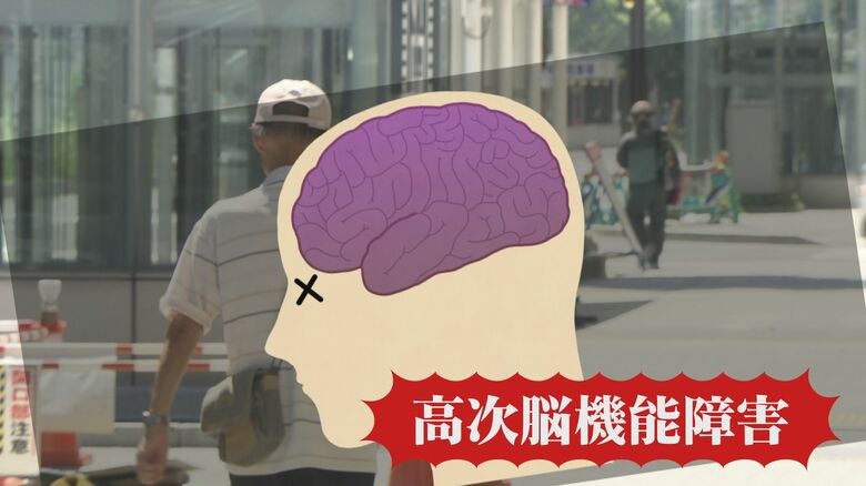 「大脳は43度で溶け始める」熱中症が引き起こす後遺症　簡単にできる“脱水”のセルフチェックで早期の対応を　｜FNNプライムオンライン