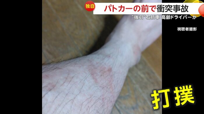 打撲の傷跡が目立つ撮影者の足