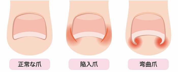 「陥入爪」（中）や弯曲爪と呼ばれる「巻き爪」（右）は代表的な足の爪トラブル（イメージ）