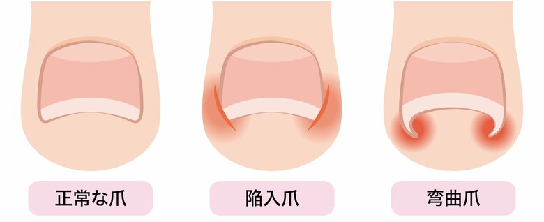「陥入爪」（中）や弯曲爪と呼ばれる「巻き爪」（右）は代表的な足の爪トラブル（イメージ）