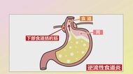放置するとがんになる可能性も　成人の10〜20%が発症する「逆流性食道炎」　食事の度に“口の中が酸っぱい”は要注意