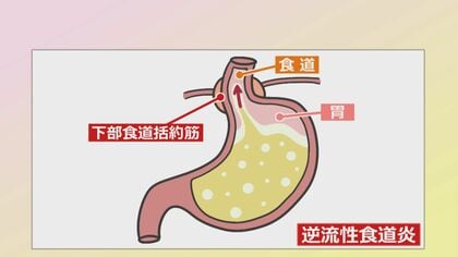 放置するとがんになる可能性も　成人の10〜20%が発症する「逆流性食道炎」　食事の度に“口の中が酸っぱい”は要注意