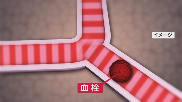 30 40代の新型コロナ患者が脳梗塞に しもやけ状になる コロナのつま先 に注意