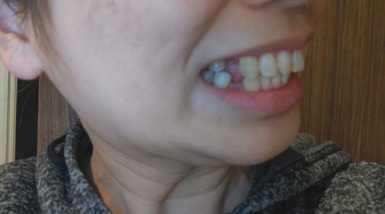 【実質無料と勧誘】歯の矯正で「すきっ歯」に　“187万円”ローンも残り…「歯科クリニックは逃げた」患者150人超｜FNNプライムオンライン