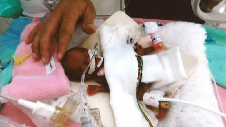 緊急帝王切開で24週と5日で生まれた竜佑ちゃん（提供：長野県立こども病院）