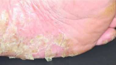 ブツブツした膿みが、手のひら・足裏に…「歯の病巣」や「タバコ」が原因かも!