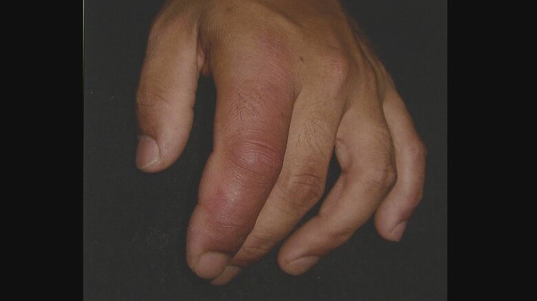 画像提供：兵庫医科大学・皮膚科学　夏秋優 教授