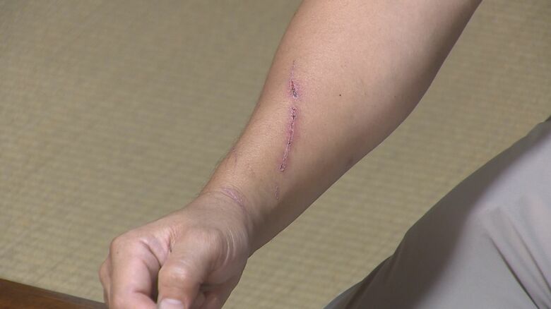 クマに引っかかれた傷跡