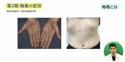 コロナ禍で「梅毒」の感染者が過去最多に…増加の理由と性感染症の症状＆治療法を専門医が解説