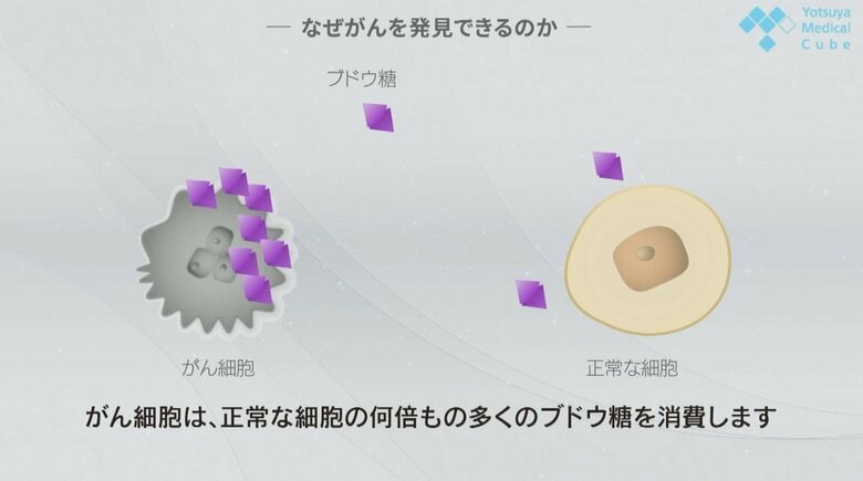 ブドウ糖を多く消費するがん細胞（提供：四谷メディカルキューブ）